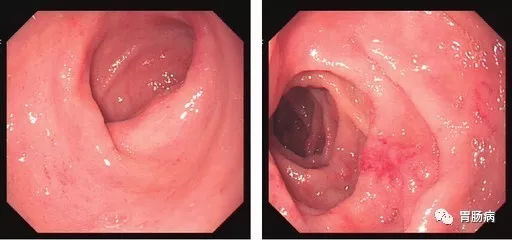 萎縮性胃炎不可怕，只要真正了解它