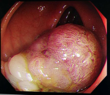 南寧直腸息肉手術多少錢